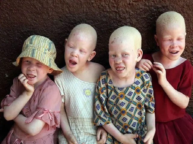 What Is International Albinism Awareness Day